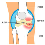 膝変形4