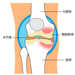 膝変形３